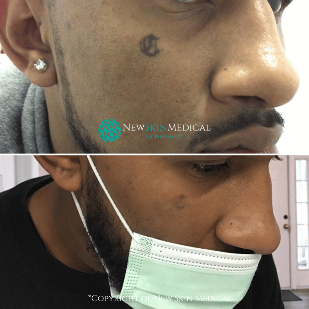 #1 Laser Tattoo Removal