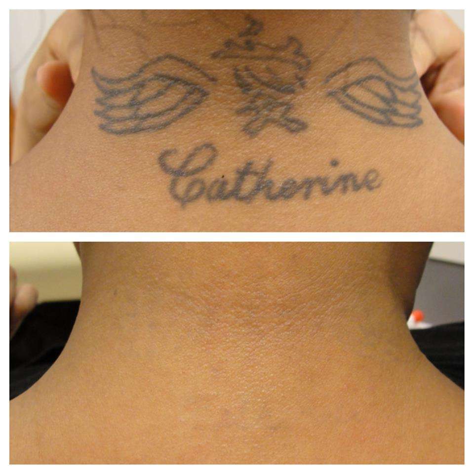 $10 Off at Atlantic Tattoo Removal
