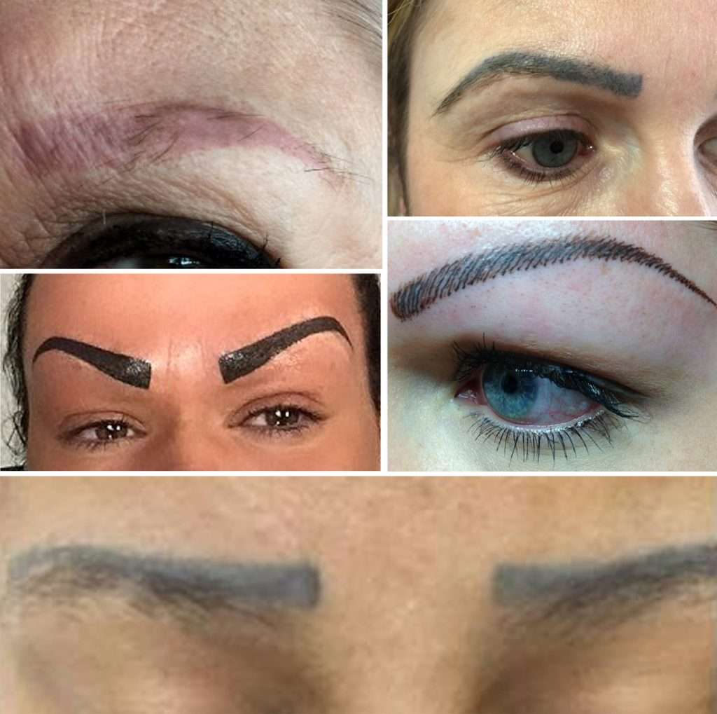 11+ Permanent Eyebrow Tattoo Removal Before And After ...
