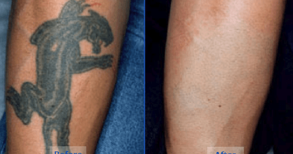 5 natural tattoo removal remedies you can try at home