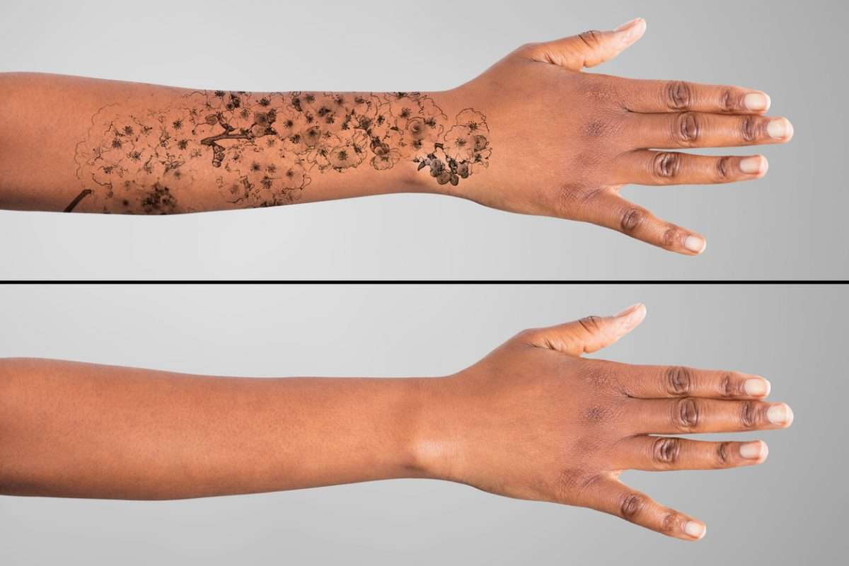 5 Tattoo Removal Options