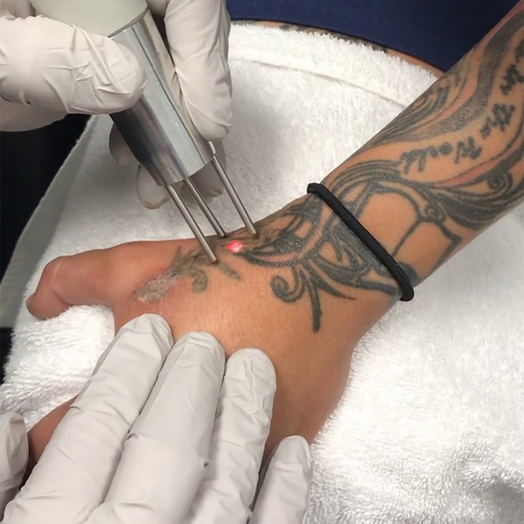 5 Things You Should Know About Tattoo Removal