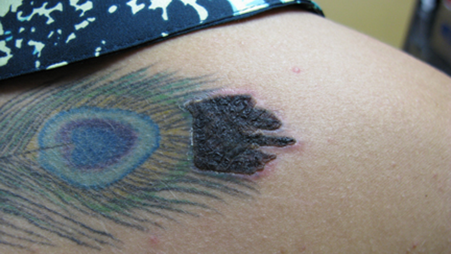 6 Possible Laser Tattoo Removal Side Effects and How to ...