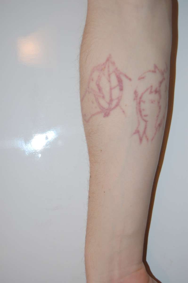 A Guide to Tattoo Excision and Laser Removal Procedures ...