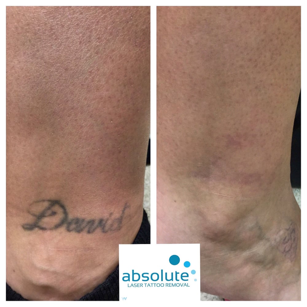 Absolute Laser Tattoo Removal