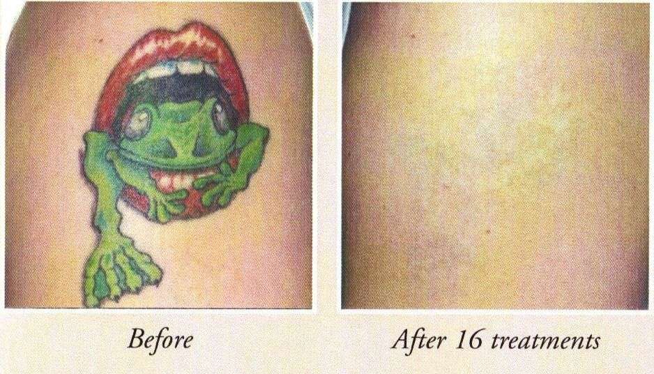 Affordable Tattoo removal #removetattoos