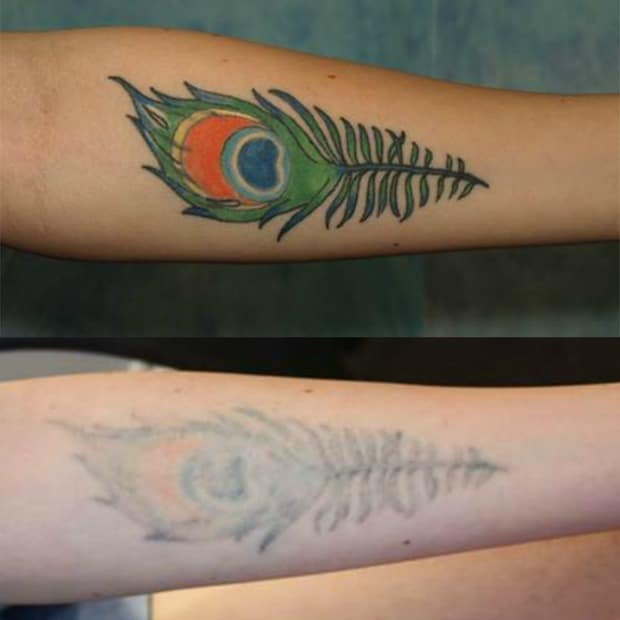 Aloe Vera Tattoo Removal