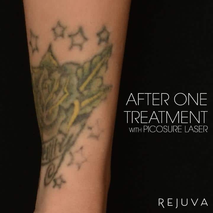 Amazing Improvement After ONLY ONE PicoSure Laser Tattoo Removal ...