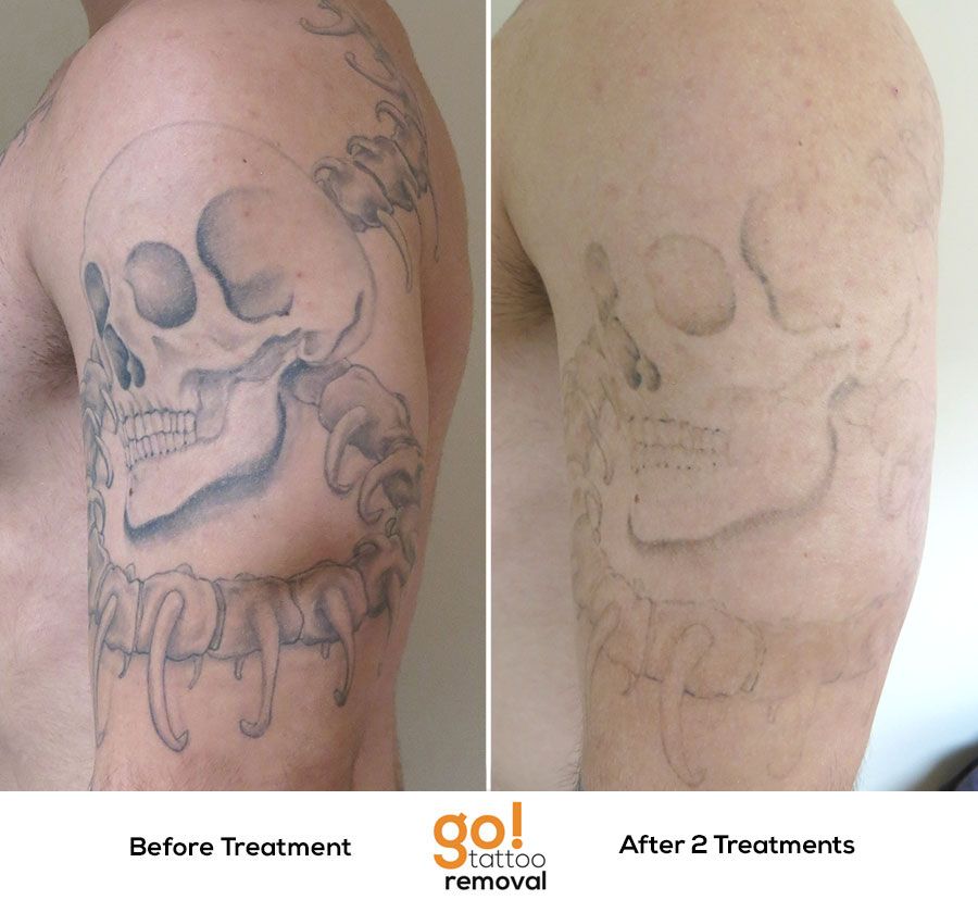Amazing progress after 2 treatments. Most tattoos won