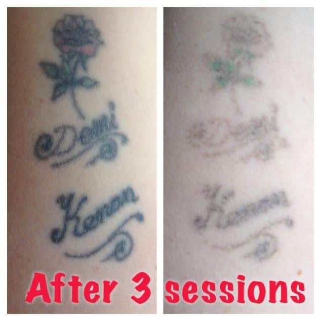 Amazing results after only 3 sessions with the laser