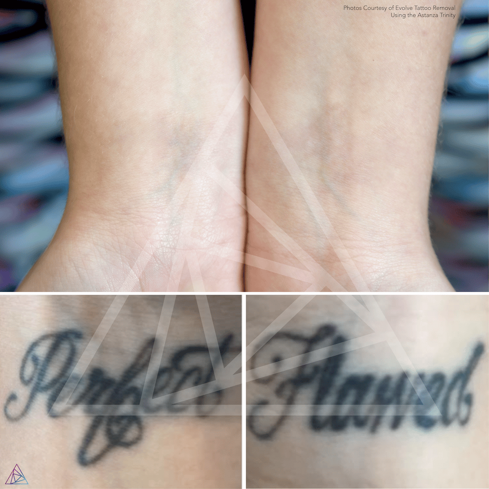Astanza Tattoo Removal Before &  After Photos, Tattoo Removal Results