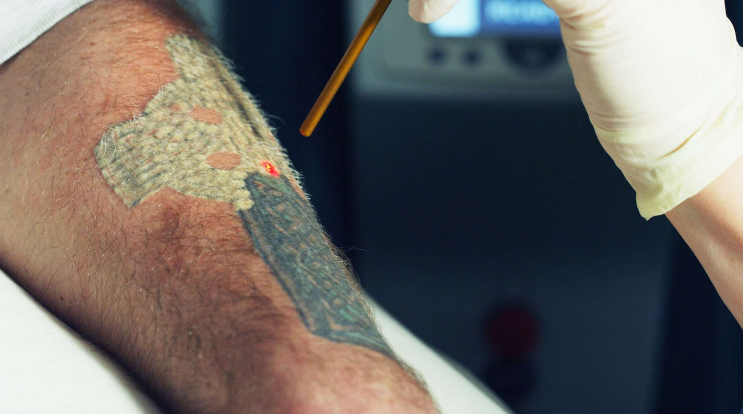 Baltimore Tattoo Removal Delivers Faster Clearance For Colorful Tattoos ...