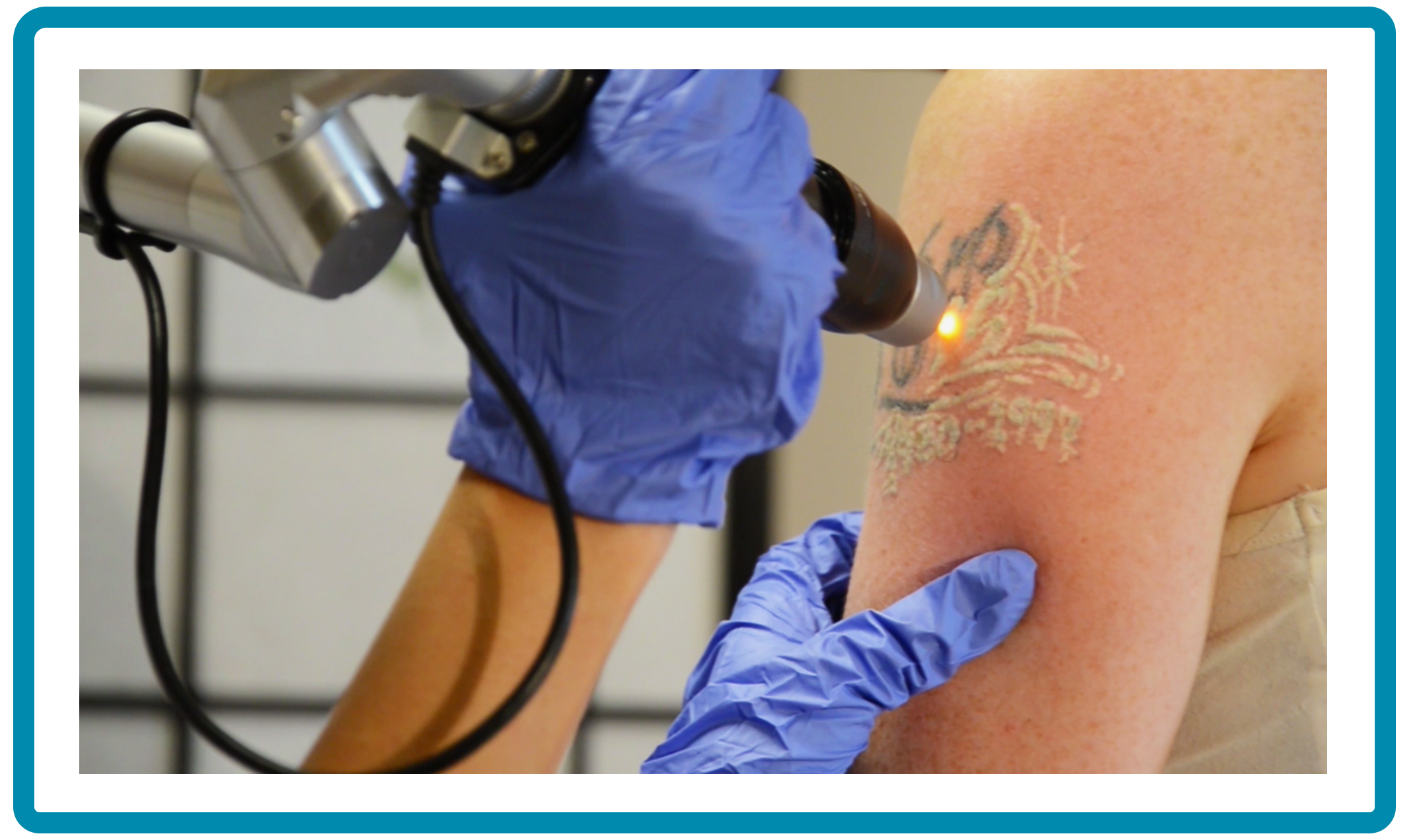 Bay Area Laser Tattoo Removal