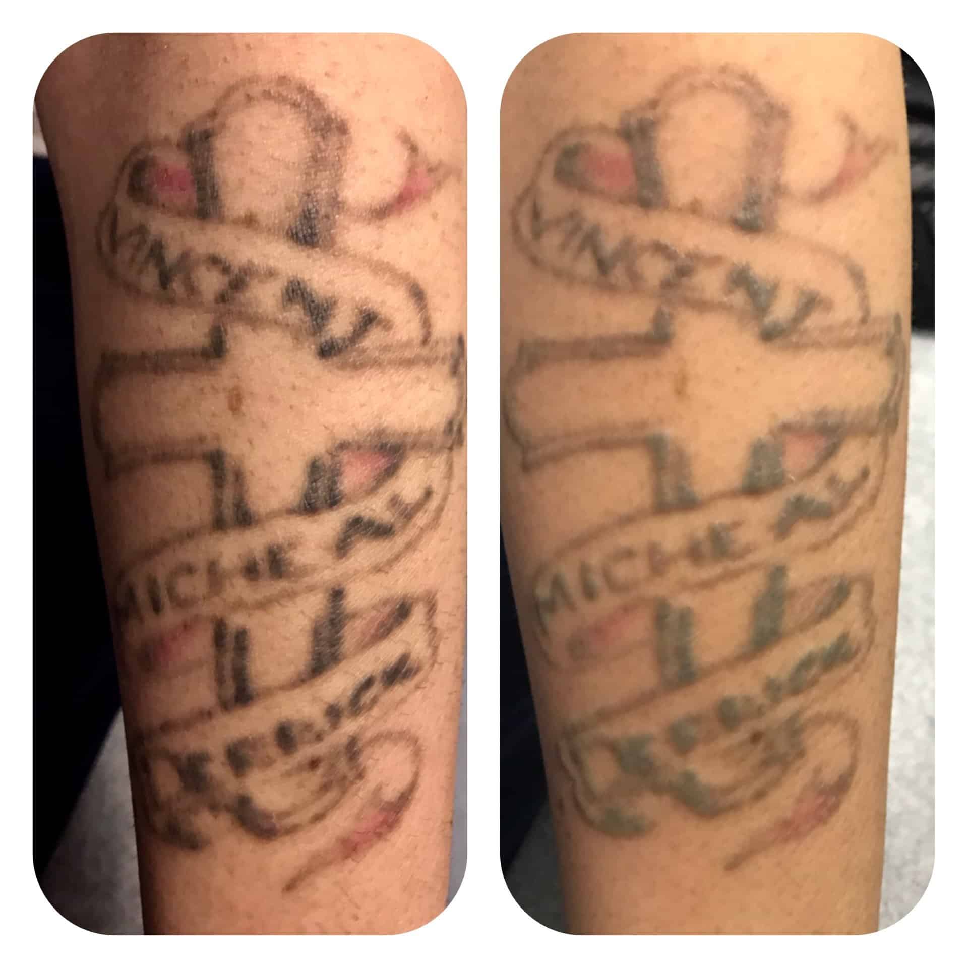 Before &  After Laser Tattoo Removal Pictures