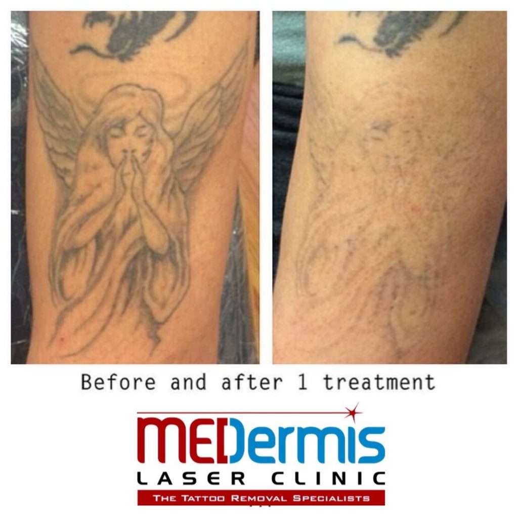 Before &  After: Tattoo Removal After One Session