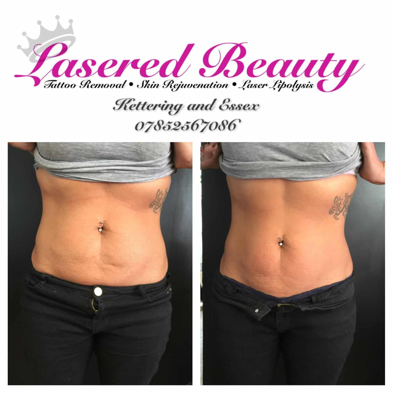 Before and After 1 Laser Lipolysis session