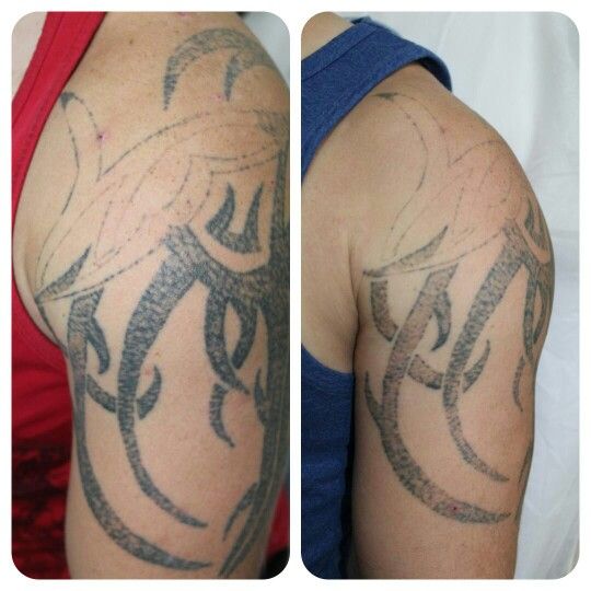 Before and after 1 session at Remove Inc Laser Tattoo Removal.