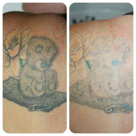 Before and after 1 session at Remove Inc Laser Tattoo ...