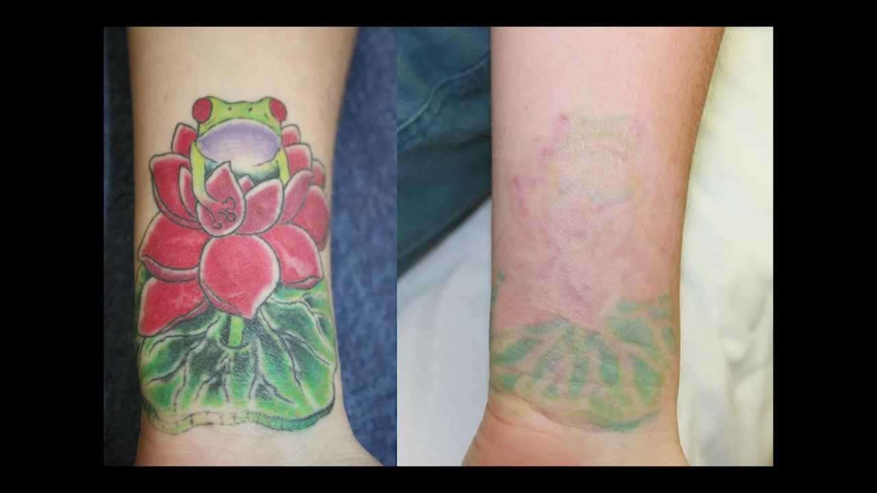 Before and After Color Tattoo Removal