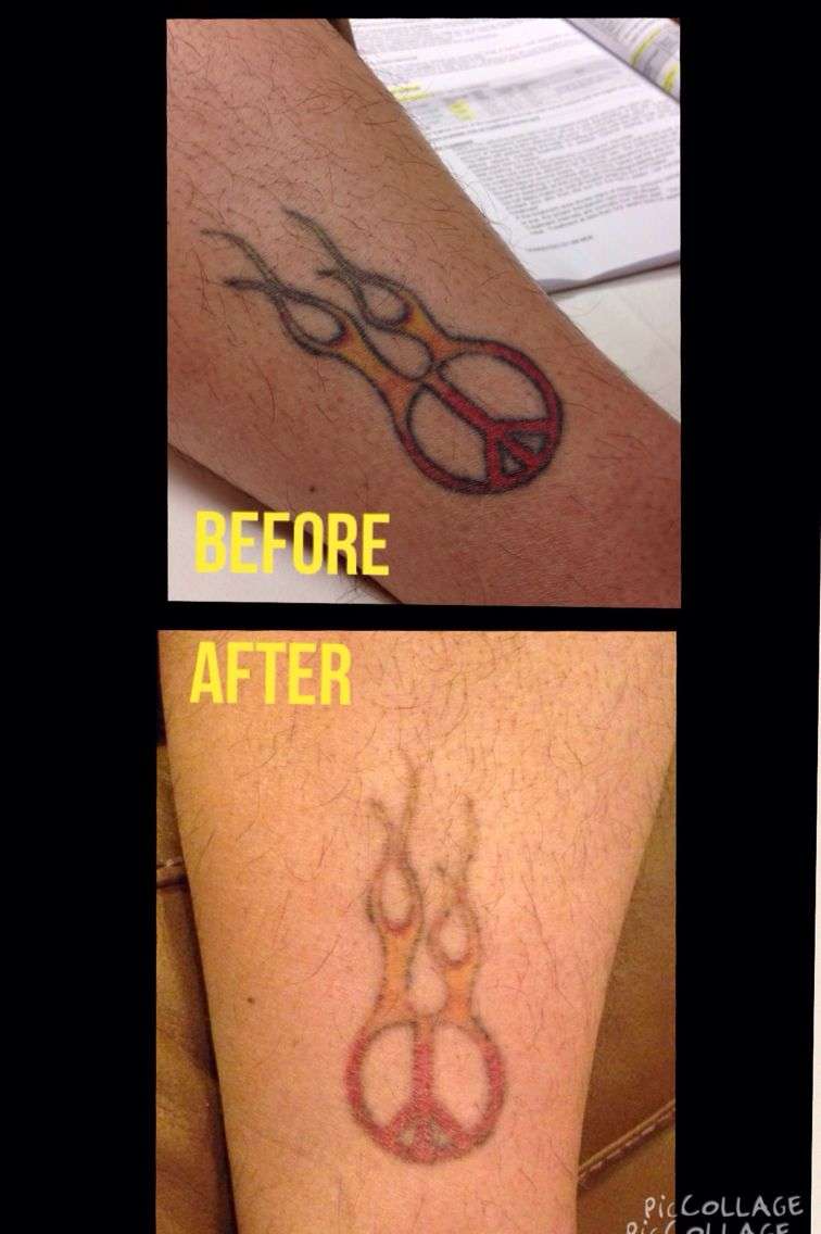 Before and After just two laser treatments at Results ...