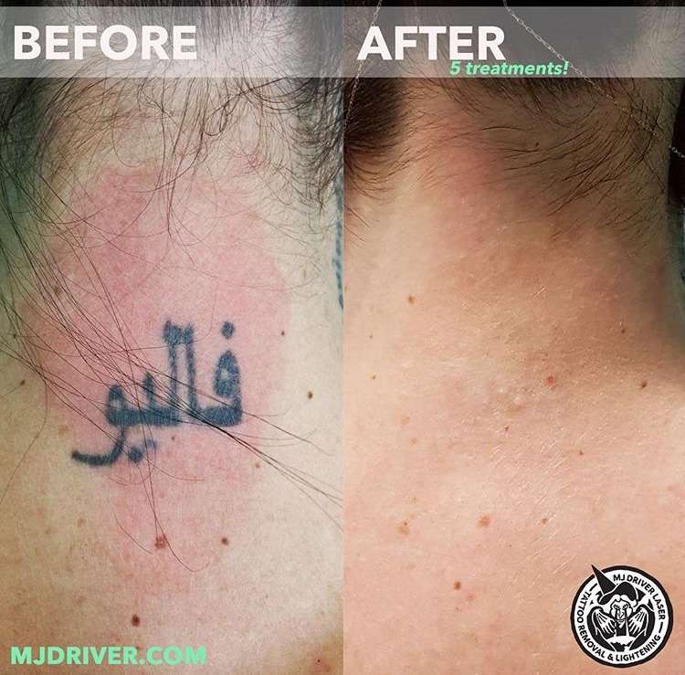 Before and After: Laser Tattoo Removal â MJ Driver Laser Tattoo Removal