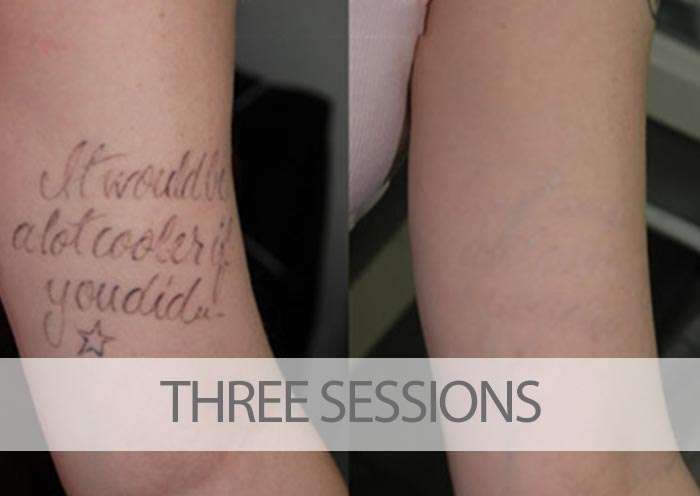 Before and After Laser Tattoo Removal Results