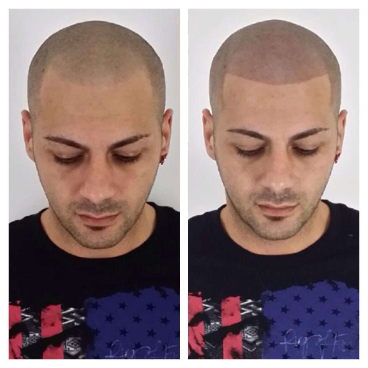 Before and after of an amazing procedure we did. We are the best in the ...
