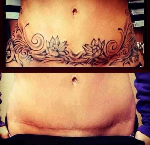 Before And After Tummy Tuck Scars Tattoos