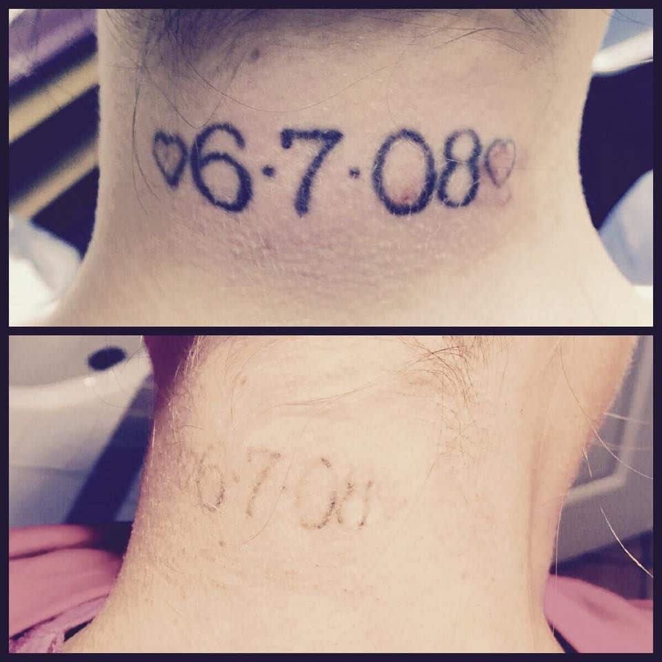 Before/After just three sessions with our Pico Technology laser! # ...
