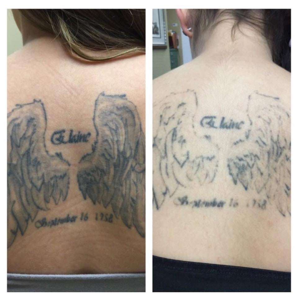 Before/After ONE session with PicoTechnology at Absolute Laser Tattoo ...
