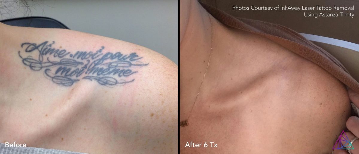 Best Completed Tattoo Removal: InkAway Laser Tattoo Removal