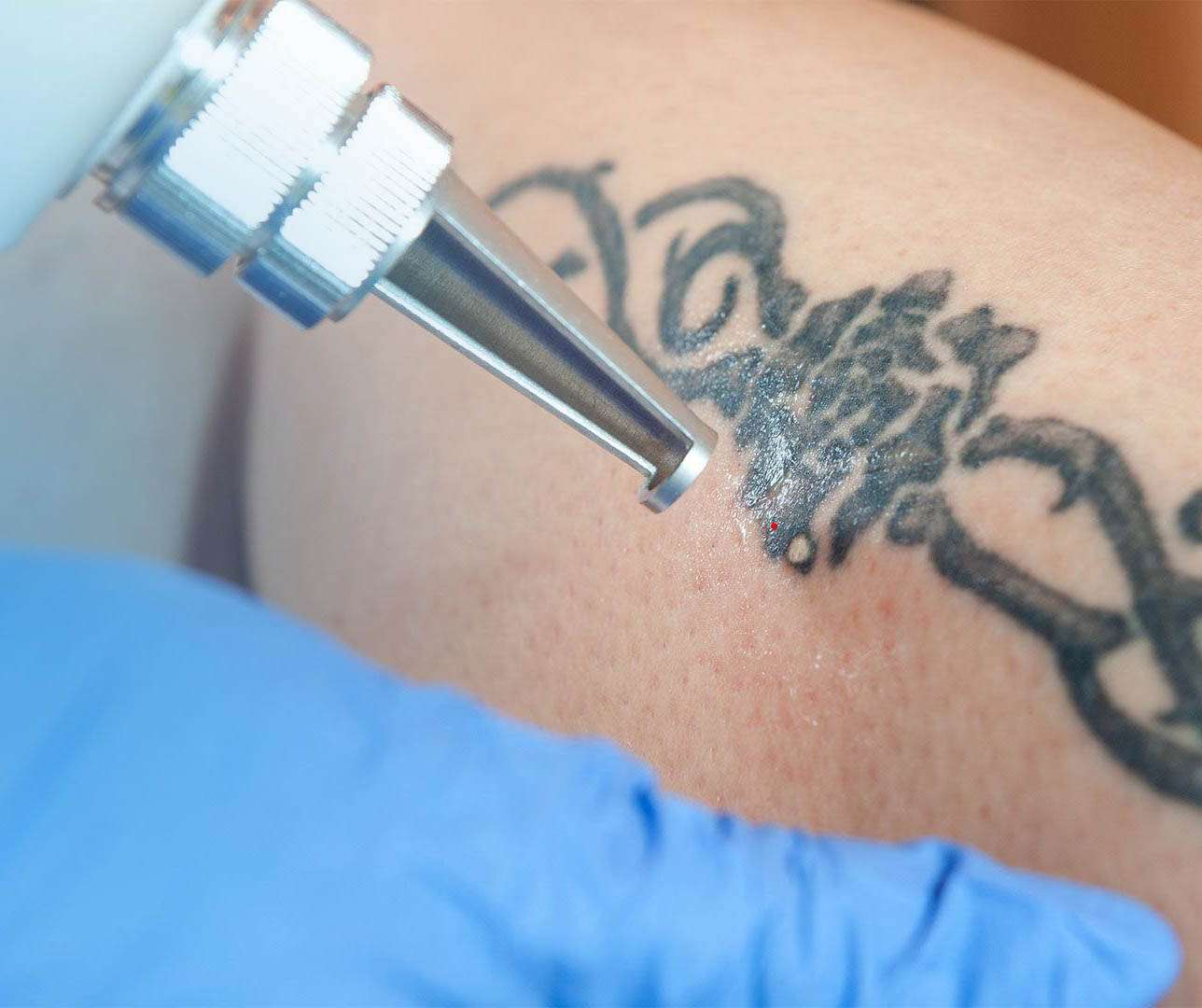 Best Laser Tattoo Removal In Portland Oregon?