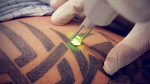 Best Places for Tattoo Removal