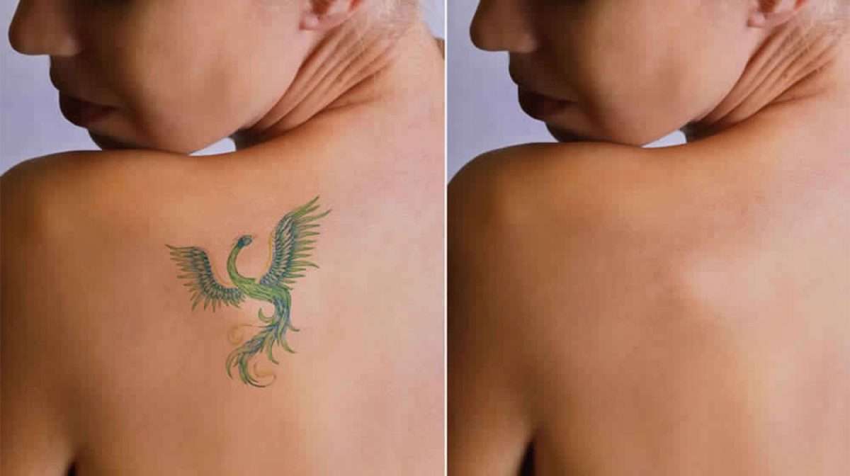 Best Skin Doctor for Laser Tattoo Removal in Delhi