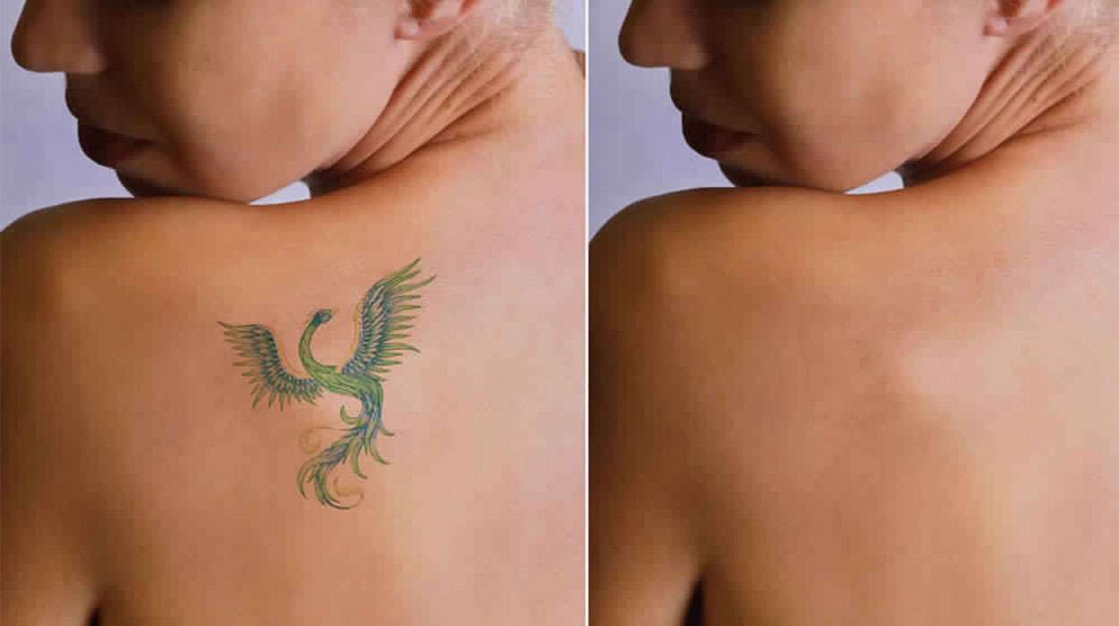 Best Skin Doctor for Laser Tattoo Removal in Delhi ...