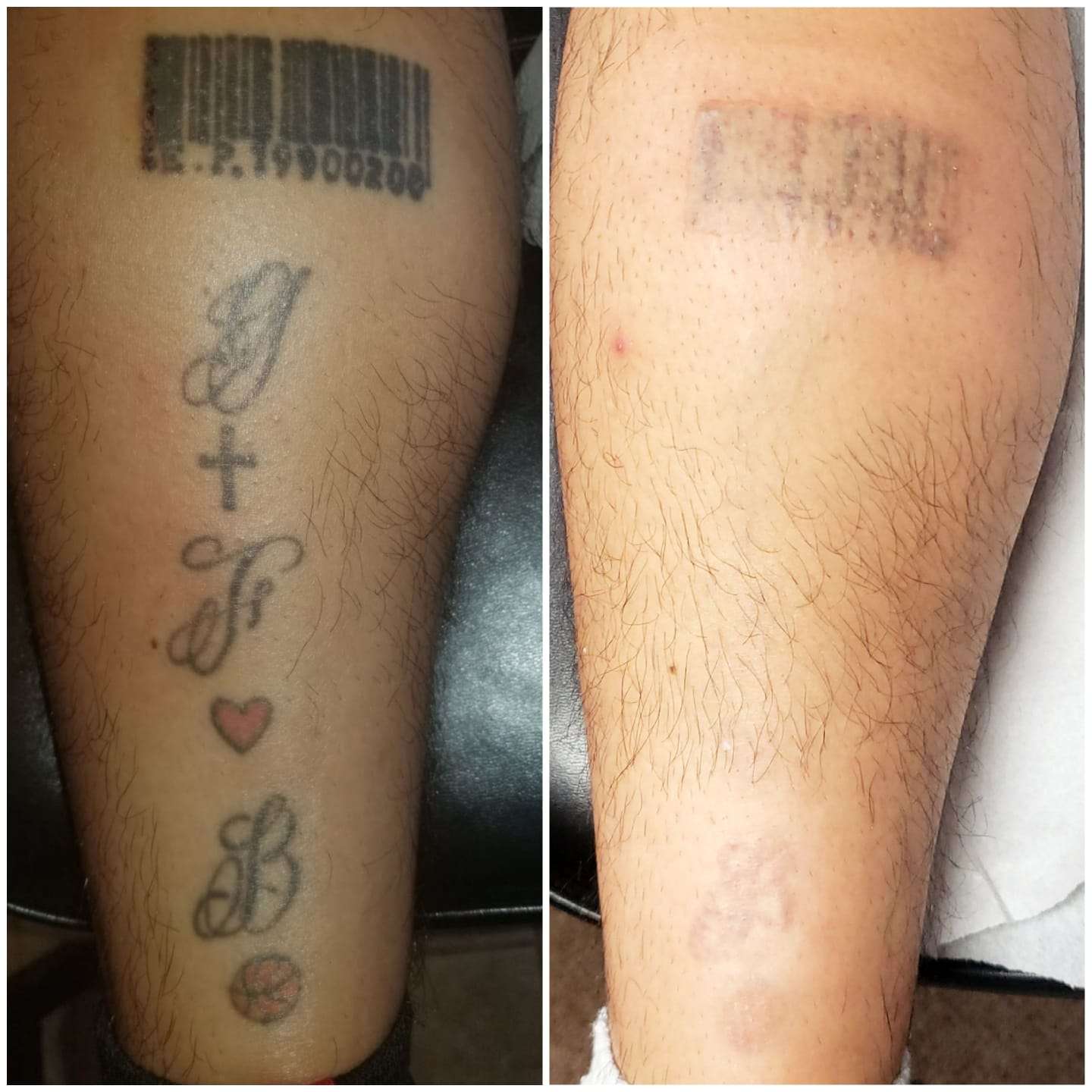 Best Tattoo Removal in Houston