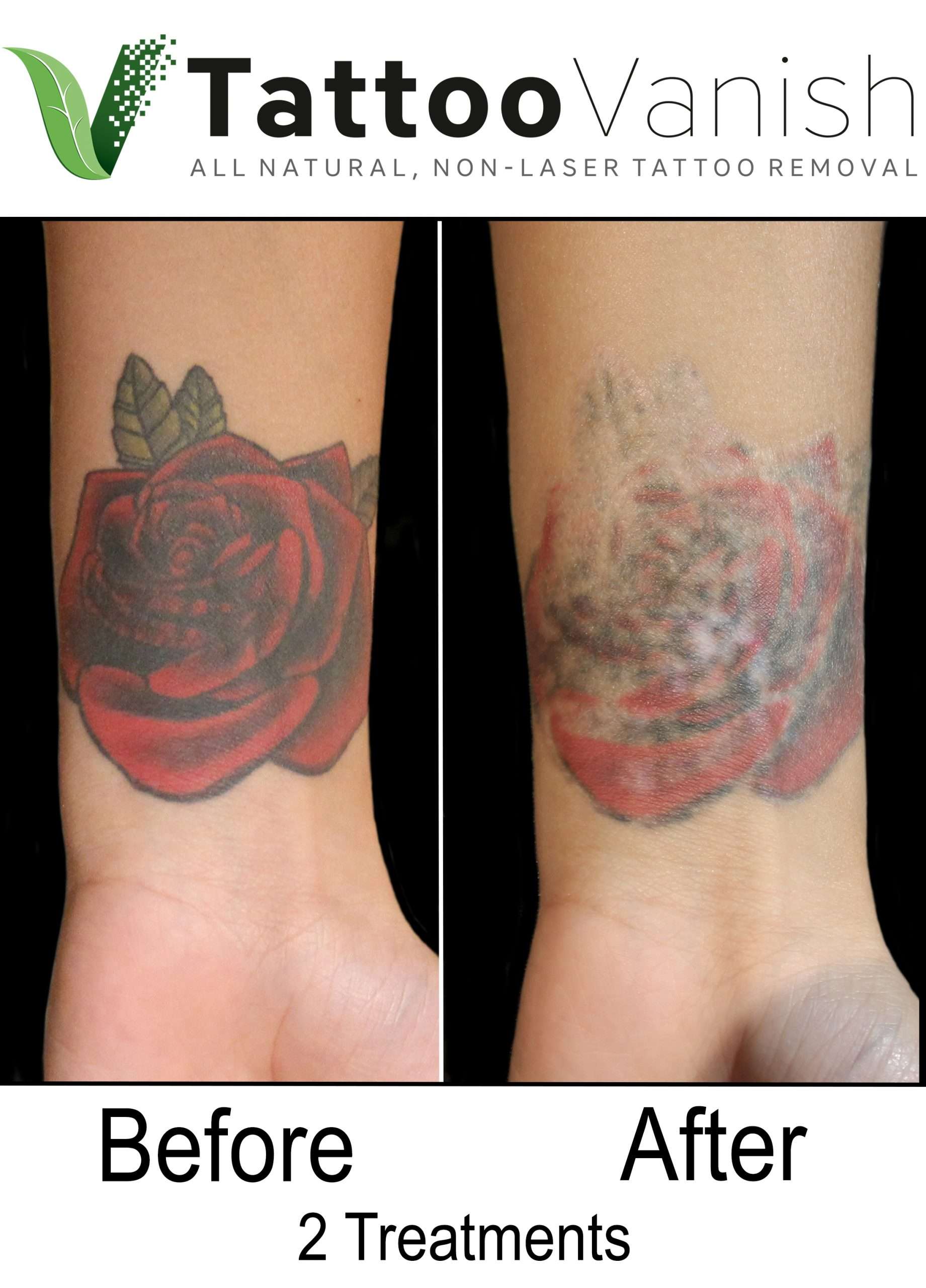 Best Tattoo Removal in Miami