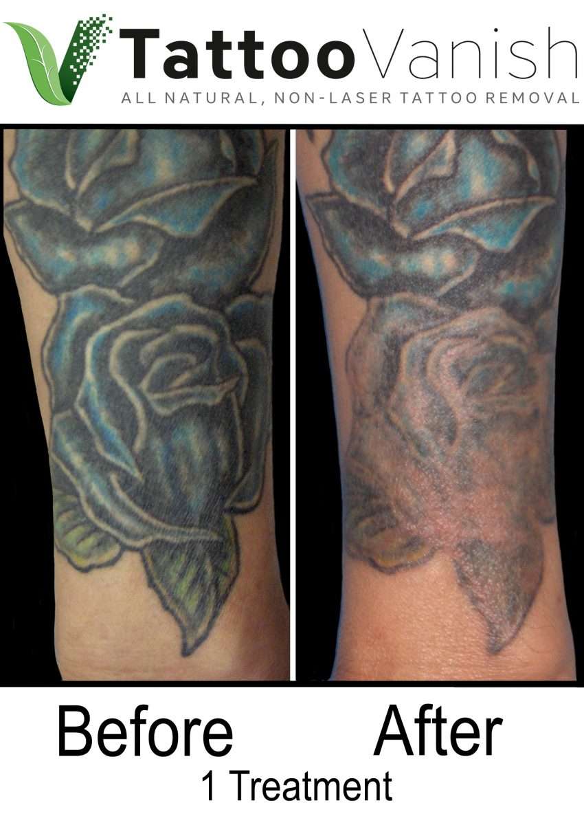 Best Tattoo Removal Nyc