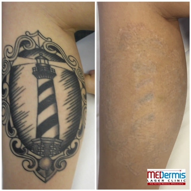 Black Laser Tattoo Removal After 3 Sessions