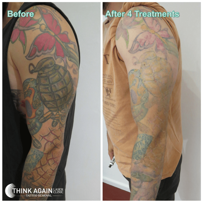 Blackout Tattoo Removal Before And After