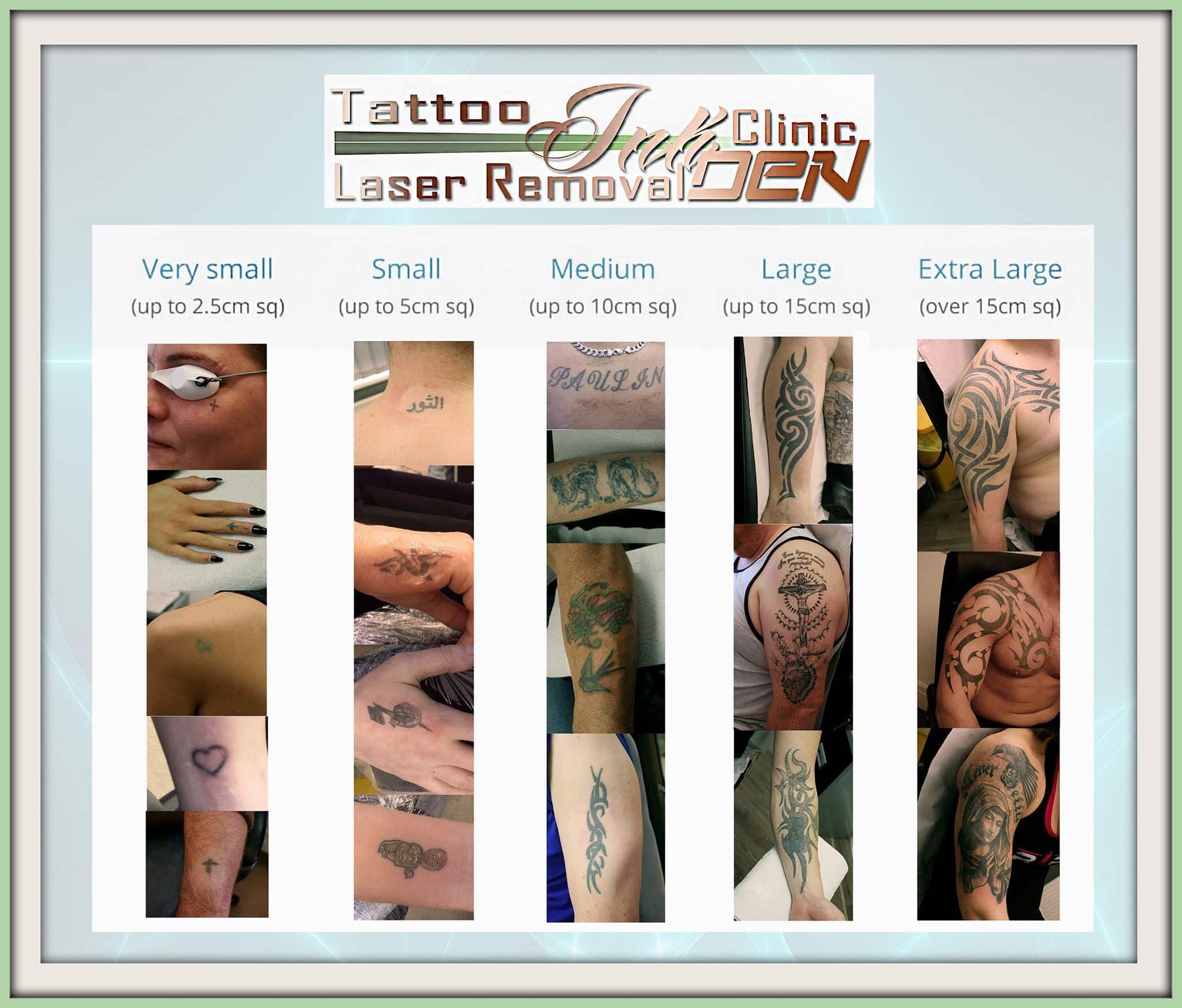 Blackpool Laser Tattoo Removal Inkden Clinic
