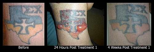 Blisters after Laser Tattoo Removal Treatments