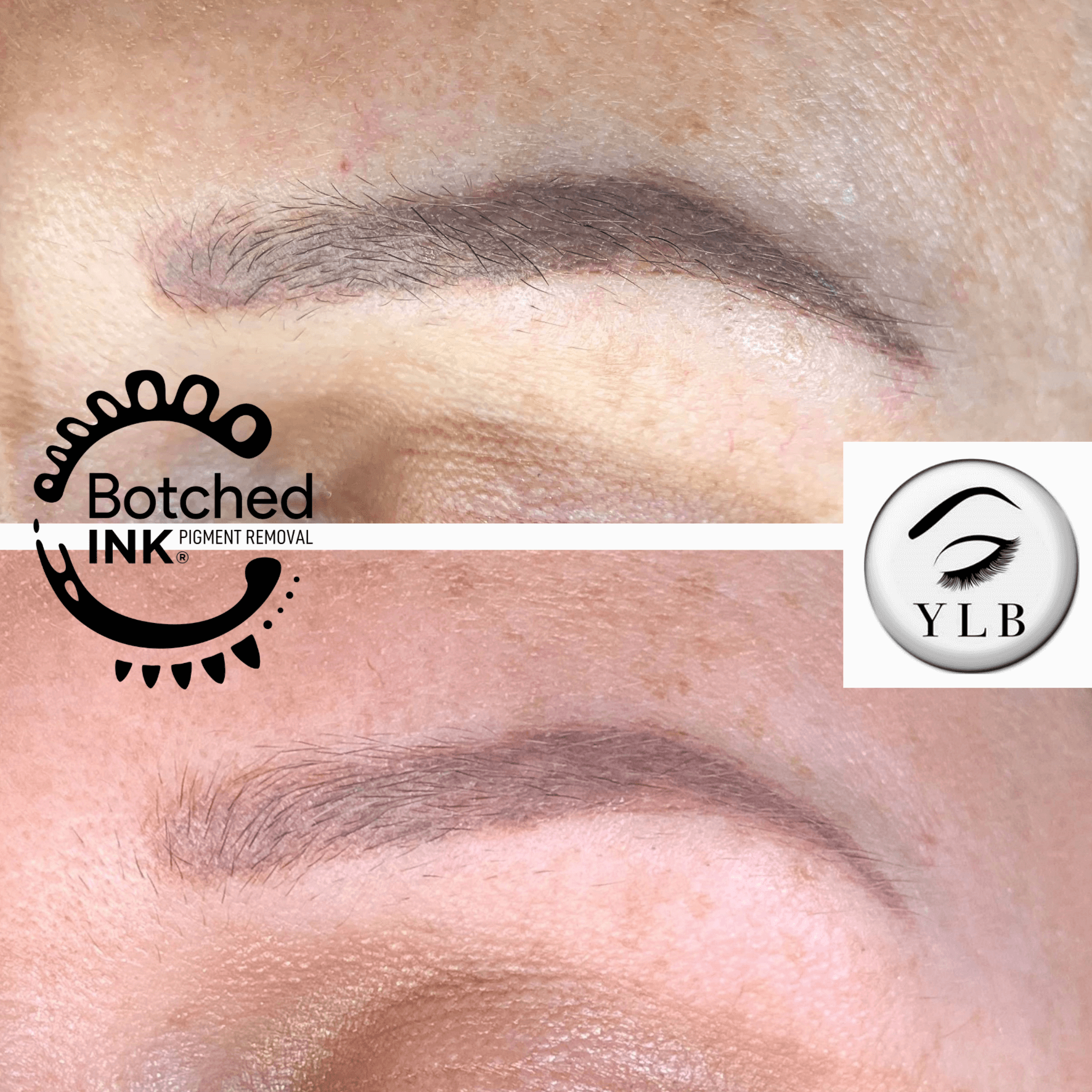 Botched InkÂ® Saline Tattoo Removal for Microblading &  Permanent Makeup