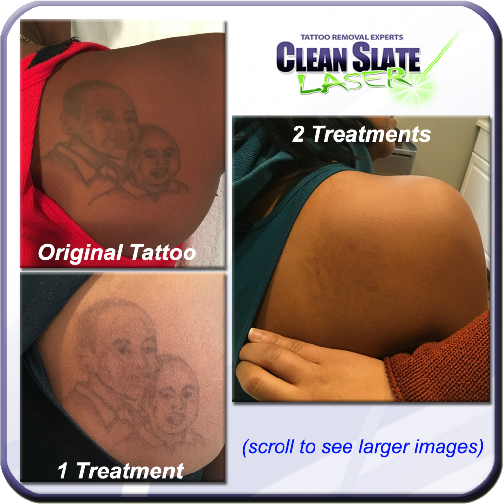 Brown Skin Tattoo Removal Dark Skin