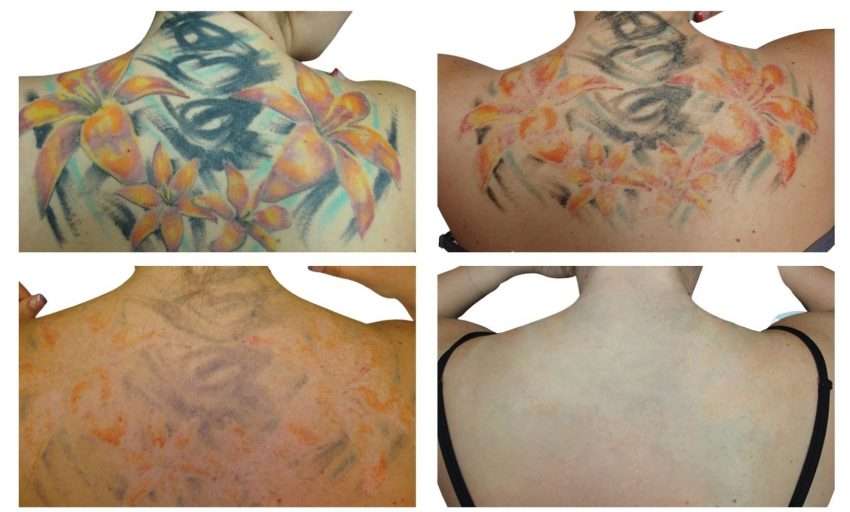 Can All Tattoos Be Removed? 6 Things You Should Know