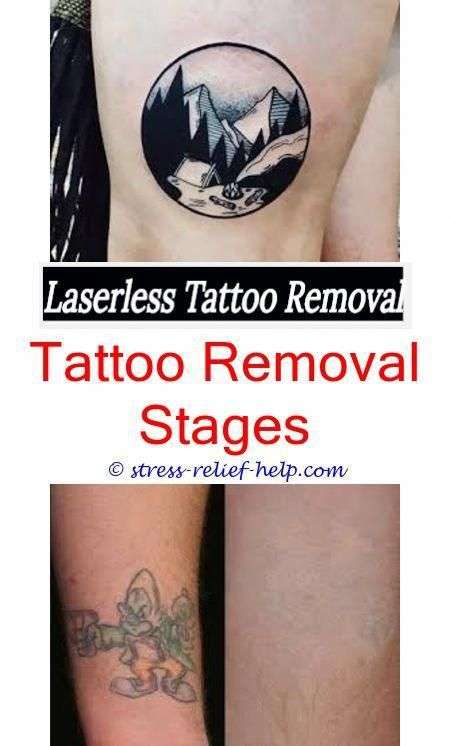 Can estheticians do laser tattoo removal.How to remove permanent tattoo ...