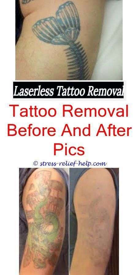 Can i get a tattoo removed while pregnant.Colorful tattoo removal ...