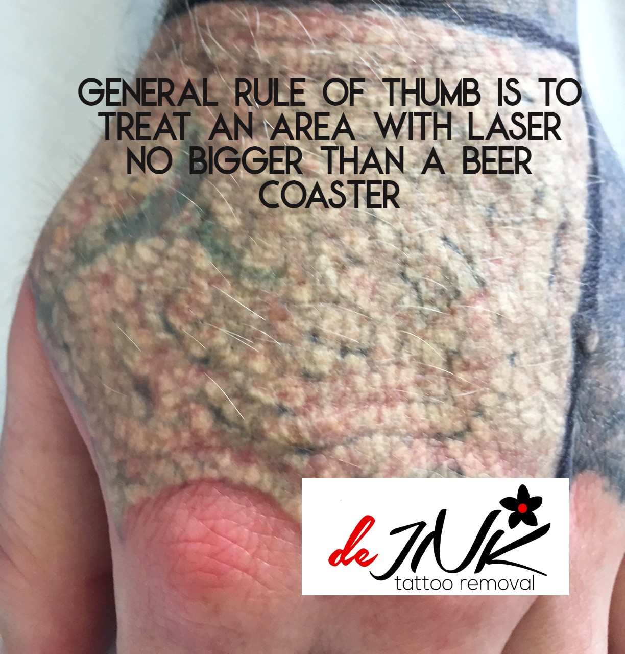 Can Laser Tattoo Removal Make You Sick?