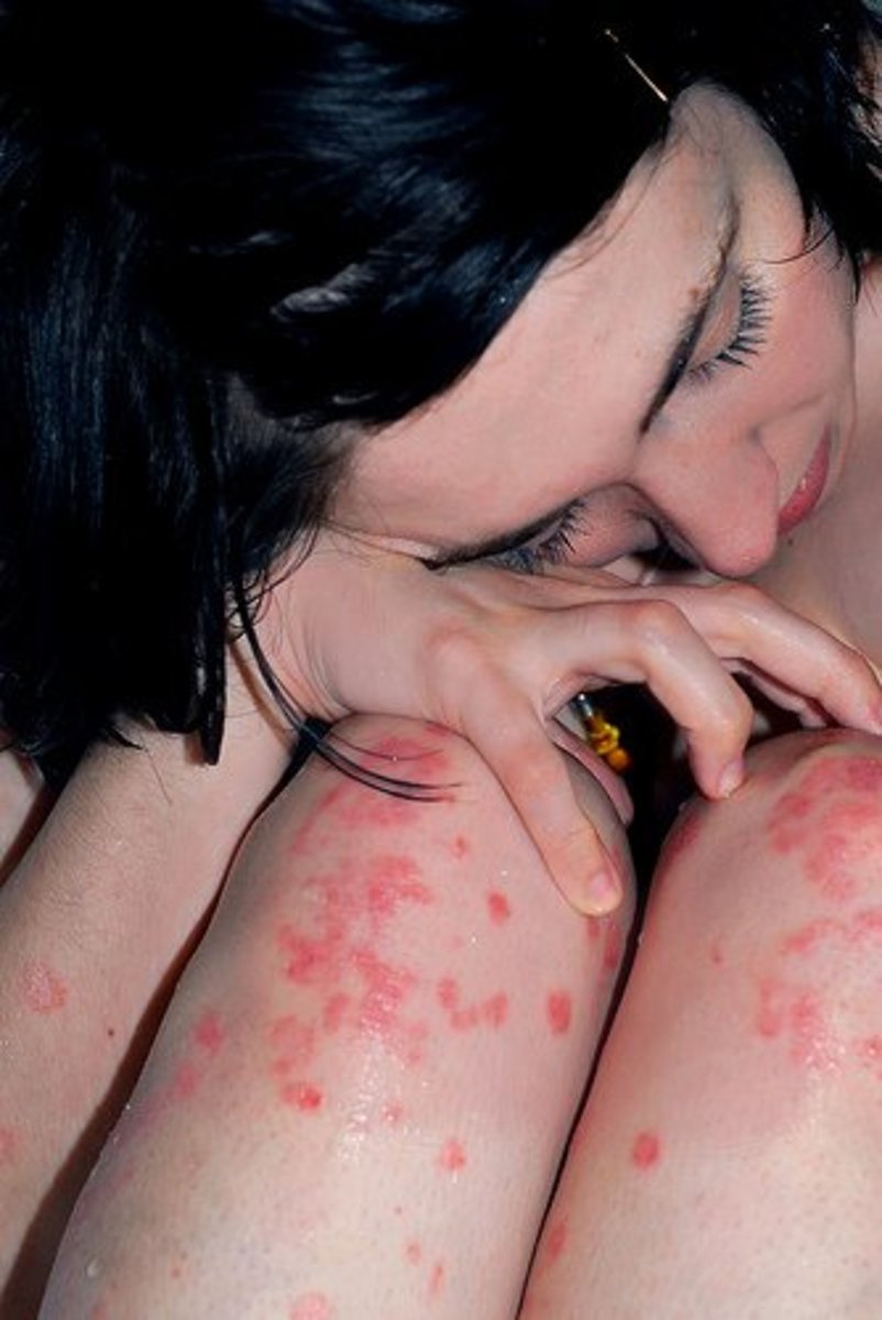 Can You Get a Tattoo If You Have Psoriasis?