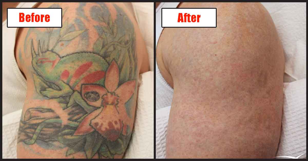 Can You Remove A Tattoo Naturally And Painlessly?